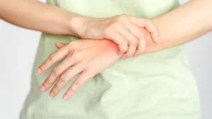 A person's hands, one grasping the other's wrist which shows a red, irritated patch on the skin.